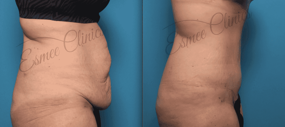 Before and After img